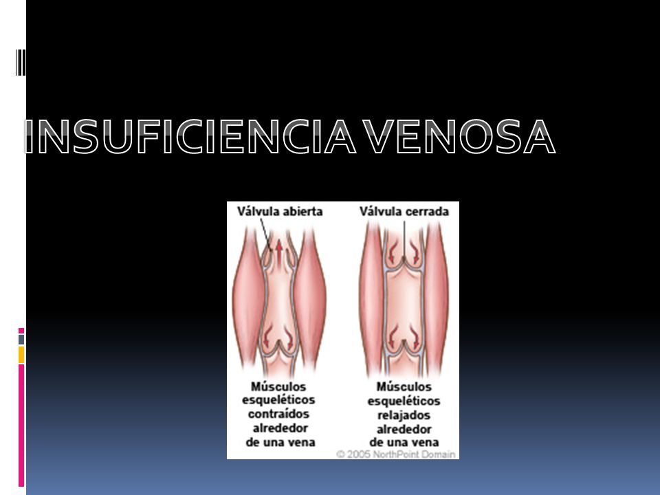 Crónica insuficiencia ppt venosa
